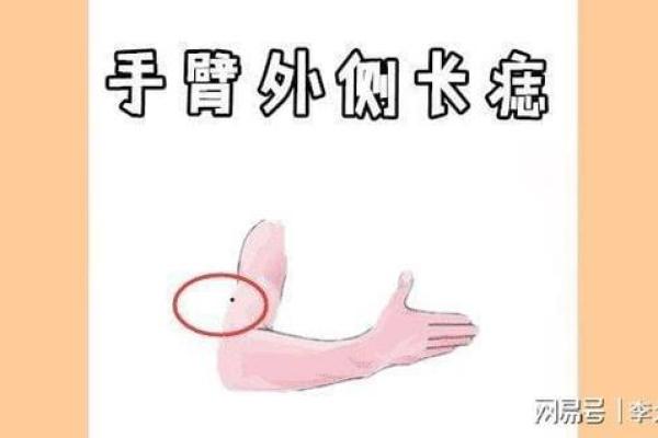 手臂痣相与人生运势的深层联系