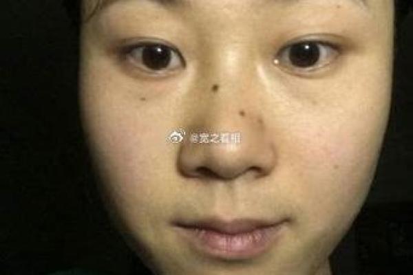 痣相流泪是否预示着情感或健康问题