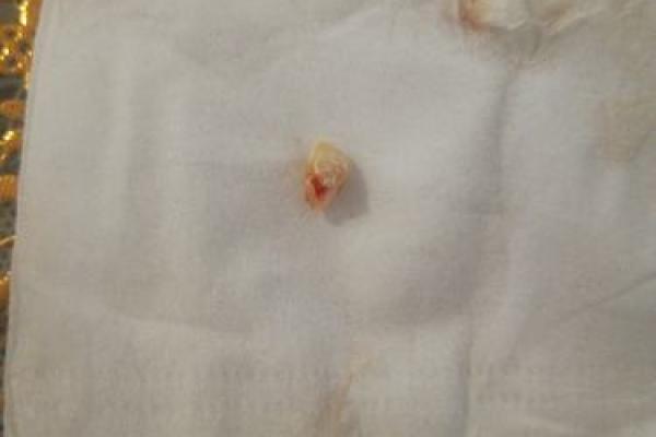 梦到牙齿掉了是吉兆还是坏兆？