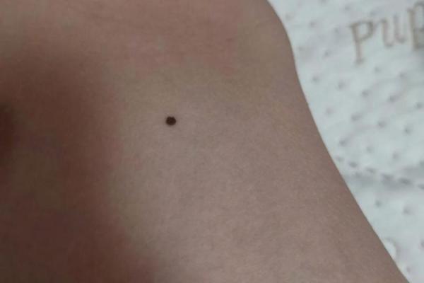 腋窝痣在面相学中的重要性