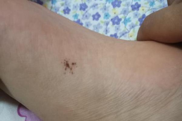 男性脚底痣相解析：揭示性格与命运的秘密