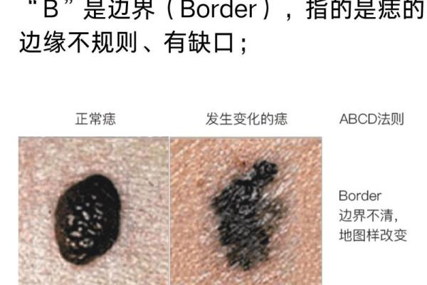 耳痣预示大运！揭秘耳长痣的五大运势解析！