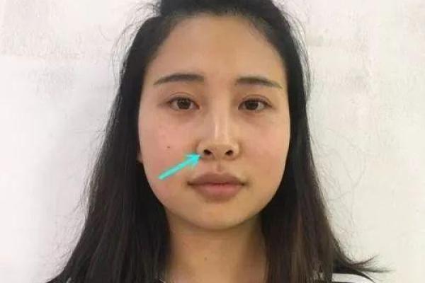 面相解析：雀斑之谜与命运之谜的交织