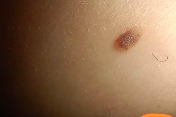 男人大腿根外侧痣，揭秘不为人知的秘密！