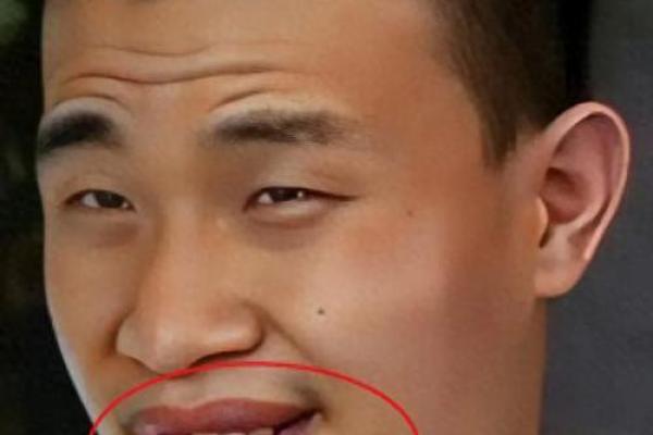 眼睛外凸面相之谜