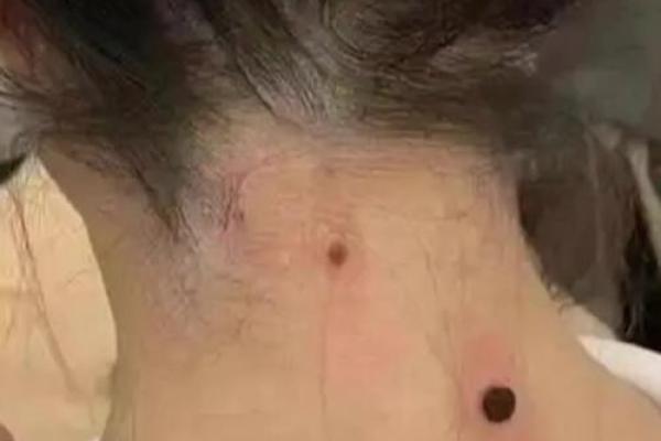 锁骨上的神秘印记：揭秘女性痣相的秘密魅力
